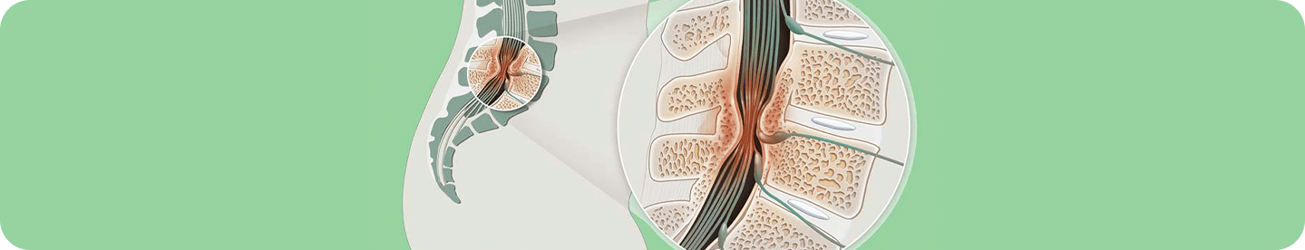 https://denissakai.com.br/wp-content/uploads/2023/10/Cirurgia-de-Estenose-de-Canal-Vertebral-cervical-e-lombar-min.png