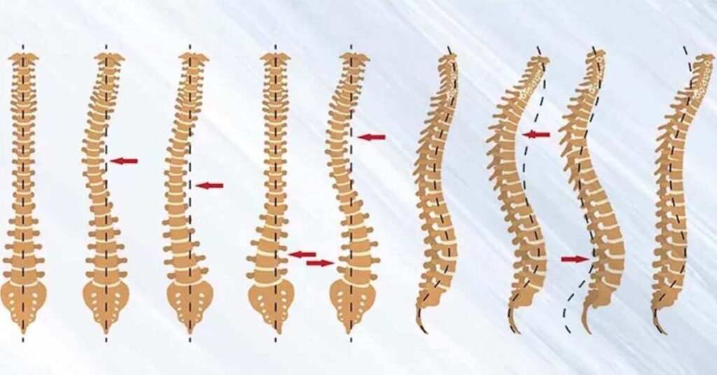 Deformidades da coluna: quando a cirurgia se torna inevitável 1 Deformidades da coluna: Quando a cirurgia se torna inevitável